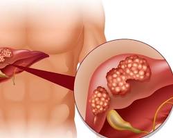 Image of Gan bị viêm